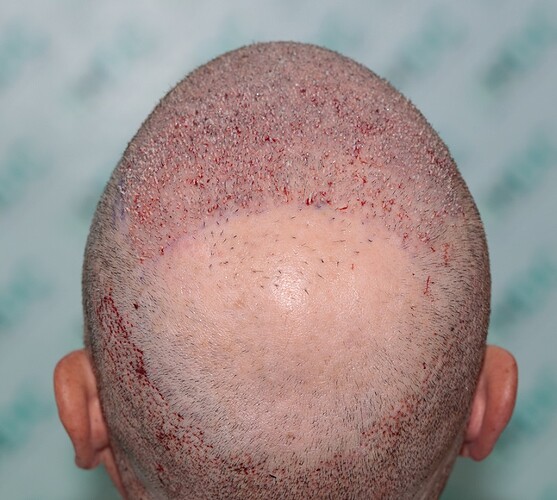 Major Repair of Mini Grafts - Result: 4160 Grafts – HDC Hair Clinic photo