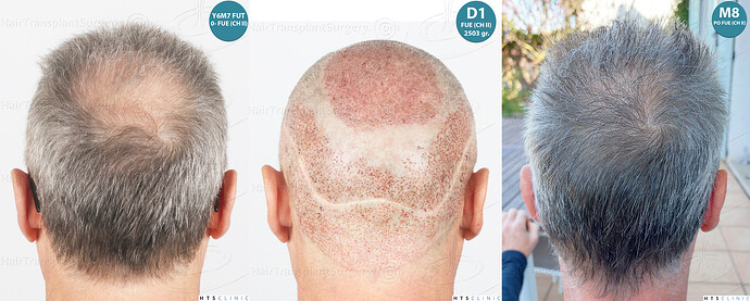 Dr Devroye + Dr Montesanti + Dr Jenard / 7015 grafts (4512 FUT + 2503 FUE) / 2 sessions photo