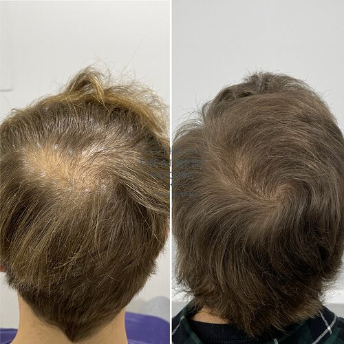 2037 Grafts Hairline and Crown Result- The Treatment Rooms London photo