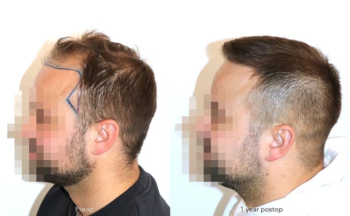 Case performed by Dr. Feriduni – 3726 FU in 1 procedure photo