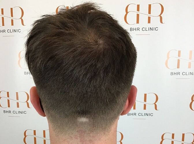 Dr.Bisanga, BHR Clinic 2858 FUE 0 - 8 Months Hair Transplant Fast, Dense & Natural Growth photo