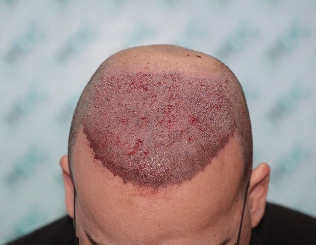 HDC Hair Clinic – FUE Hair Transplant Result for 4534 Grafts photo