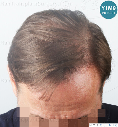 Dr. Jean Devroye, HTS Clinic / 5280 FUE (2008 + 2018 + 1254) / 3 sessions photo