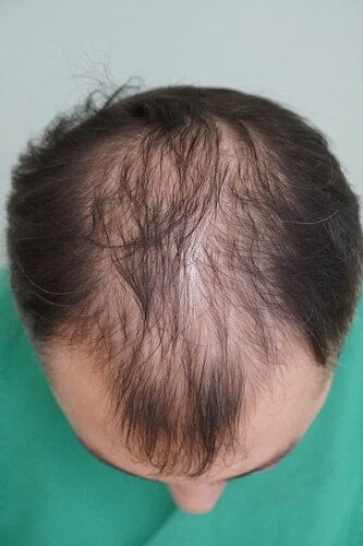 Hattingen Hair Clinic, 4 435: 4 093 FUT and 342 FUE. photo