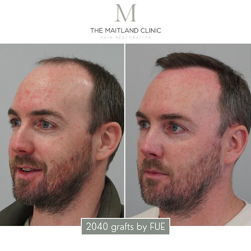 2468 grafts by FUE - Dr Ball, The Maitland Clinic photo