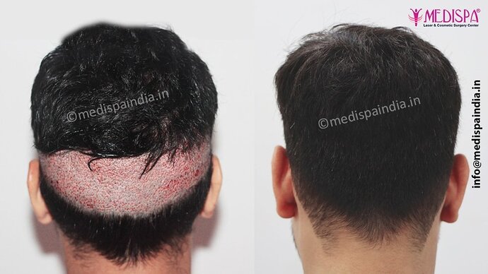 Dr. Suneet Soni - 2500 FUE Grafts, NW- III photo