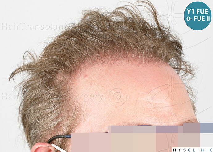 Dr. Jean Devroye, HTS Clinic / 6494 FUE-BHT (3150 + 3344) / NW VII, 2 sessions photo