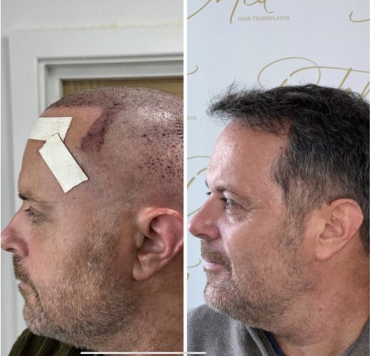 Dr Ted Miln (UK) | 6,120 grafts | FUT+FUE combo | Hairline, midscalp & crown restoration | 8.5 months post-op photo