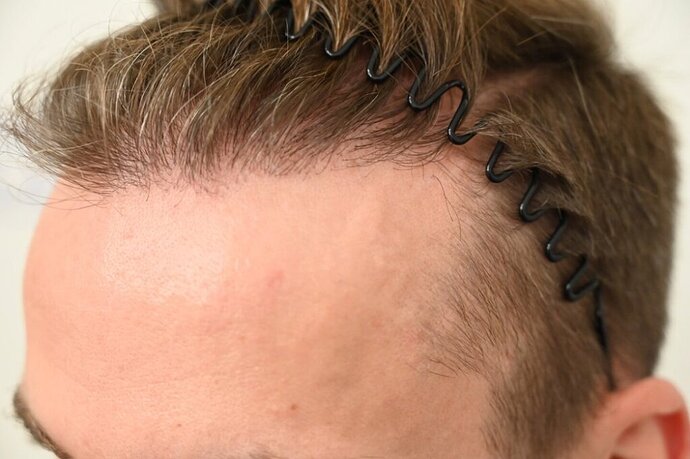 Ozlem Bicer MD-2340 Grafts FUE by micro-motor, 12. month result  photo