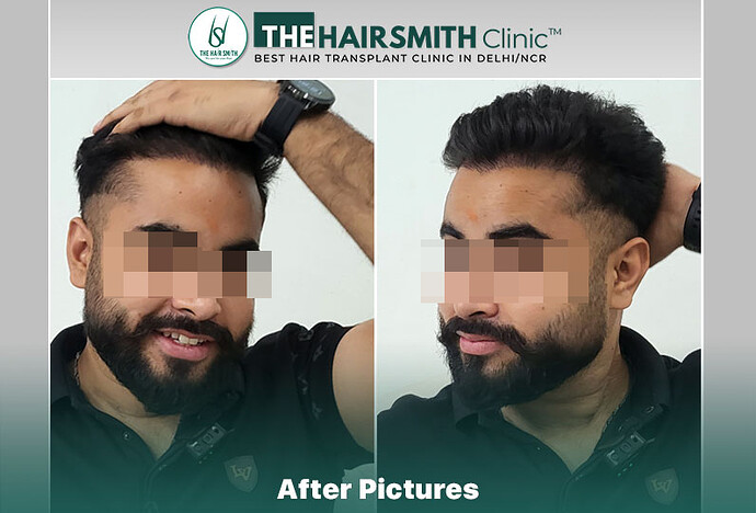 The HairSmith Clinic™ | NW Stage 3 | 1675 Grafts | 9 Months Hair Transplant Result photo