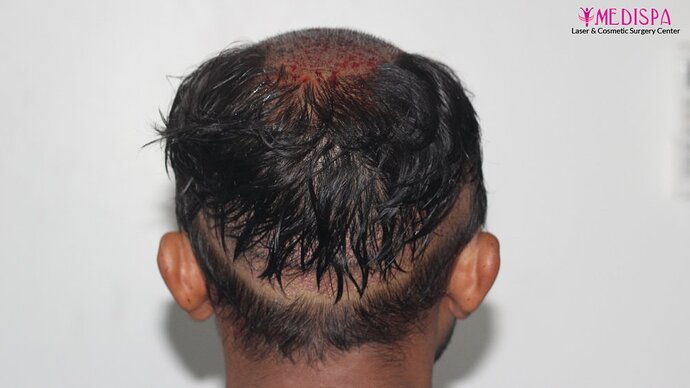 Dr. Suneet Soni - 5587 Grafts, Combine FUT + FUE + Beard Technique, NW : V-VI photo
