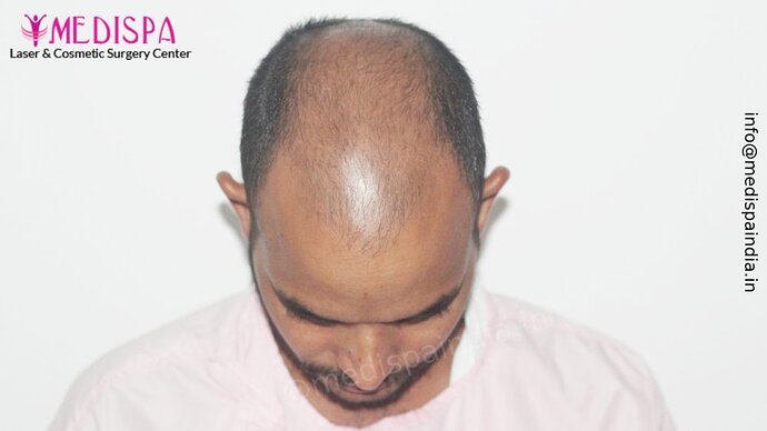 Dr. Suneet Soni - 5294 Grafts, Combine FUT + FUE + Beard Technique, NW- VI, 2 Years Result photo