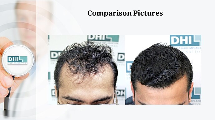 DHI India | NW 2 | 1,359 Grafts | 7-Months DHI Hair Transplant Results photo