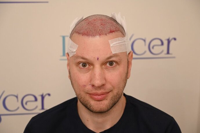 Ozlem Bicer MD-Hair Transplant-2910 Grafts FUE by micro-motor, 7. months result photo