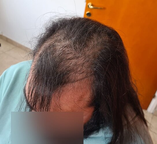 Density Enhancement Result for 4516 FUE Grafts – HDC Hair Clinic – 1 Year Post-Procedure photo