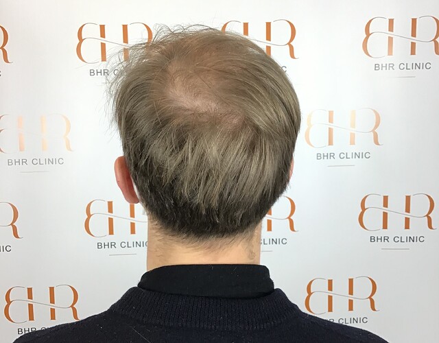 Dr. Bisanga + Dr. Kostis - BHR Clinic - Fine Hair - 2800 Grafts - 0 - 13 Months photo