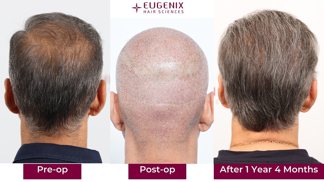 https://cdn.forumhairtransplant.com/optimized/3X/c/a/ca61bb9dfb8ba99c4a2015281b351613826b4c20_2_1035x582.jpeg
