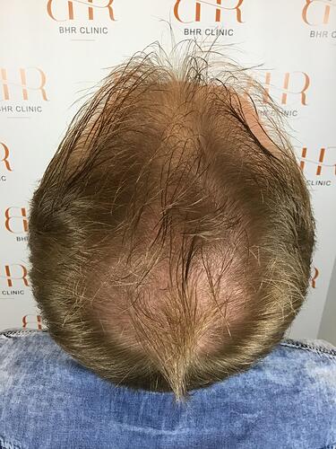 Dr. Bisanga BHR Clinic - 3001 FUE 0 - 15 Months - Fine Blond Hair photo