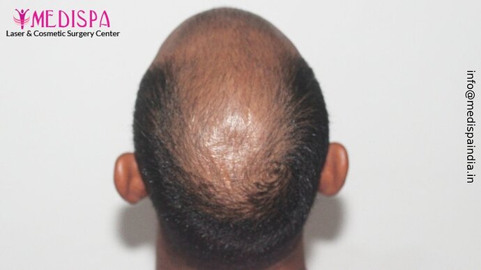 Dr. Suneet Soni - 5294 Grafts, Combine FUT + FUE + Beard Technique, NW- VI, 2 Years Result photo