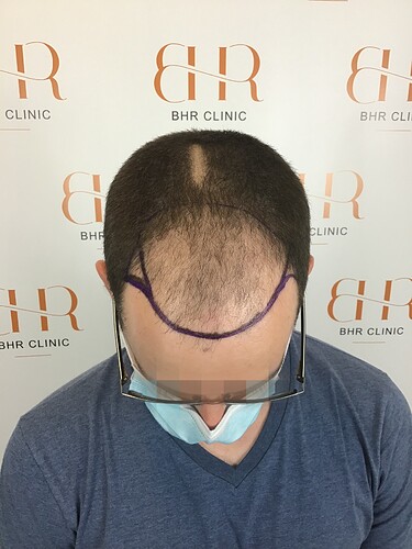 Dr. Bisanga - BHR Clinic - 4000 FUE 0 - 8 Months photo