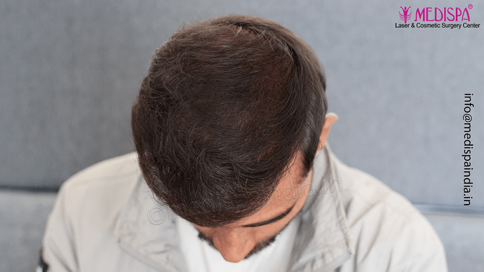 Dr. Suneet Soni - 5360 Grafts | 12-Month Result | Combination FUT + FUE + Beard photo
