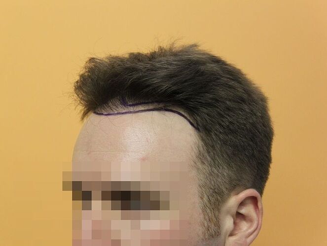 Dr.Bisanga, BHR Clinic, 1675 FUE, 0 - 13 Months photo