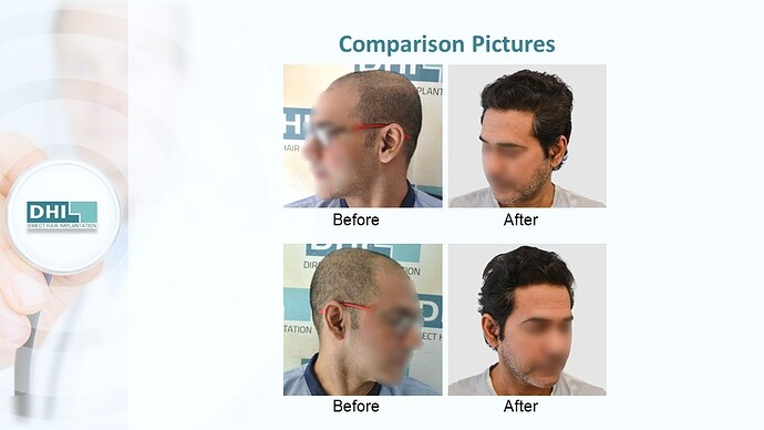 DHI India™ | NW 4 | 3,759 Grafts | 1 year DHI Hair Transplant Results photo