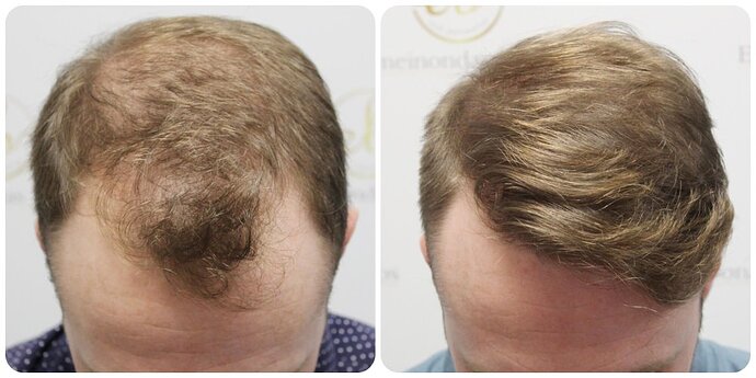 Dr Bonaros, Glasgow, UK / 1819 FUE grafts / 0-12 Months photo