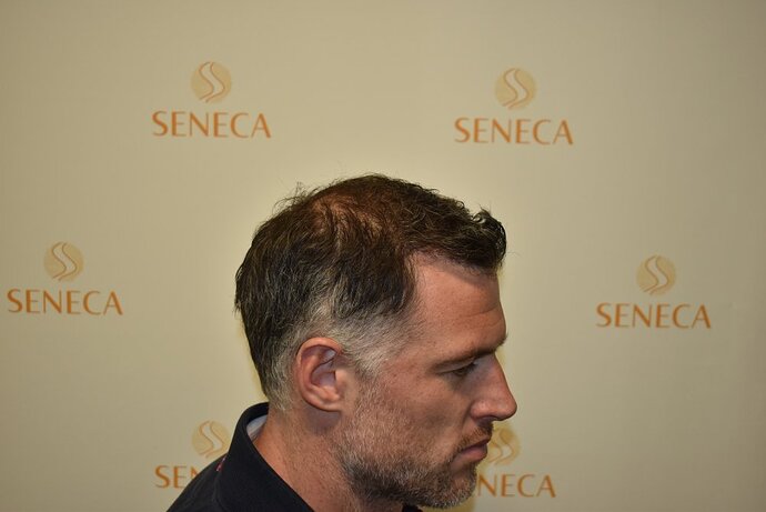 Sharing Tim Visser's Hair Transplant Journey at Seneca Medical Group photo