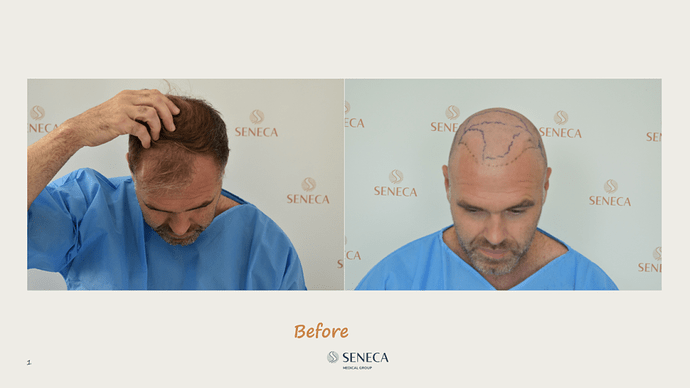 Seneca Medical Group - 2300 grafts with Direct Fue photo
