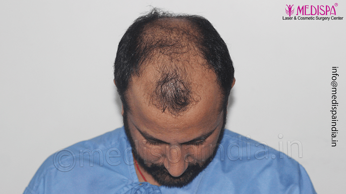 Dr. Suneet Soni - 5334 Grafts, Combine FUT + FUE + BHT (Beard) Technique, NW- V photo