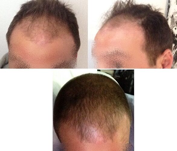 Dr. Bisanga, BHR Clinic, 3344 FUE - 10 Months photo