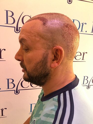 Ozlem Bicer MD-Hair Transplant-3560 Grafts FUE by micro-motor, 9. months result photo