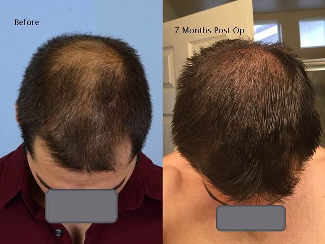 Dr. Ron Shapiro – 7 Months FUE Result-2606gr/5364 hairs photo