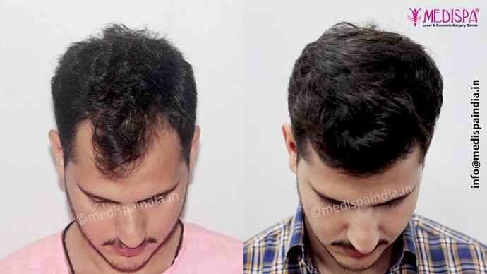 Dr. Suneet Soni - 2500 FUE Grafts, NW- III photo