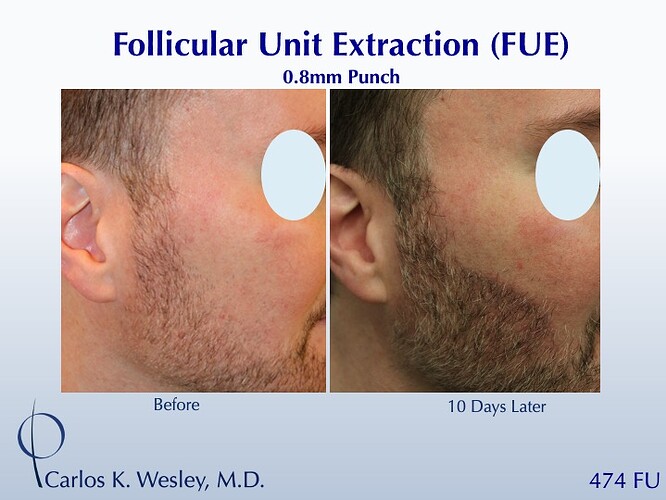 Formation of Beard (474 FUE beard grafts): Carlos K. Wesley, M.D. (NYC & LA) photo