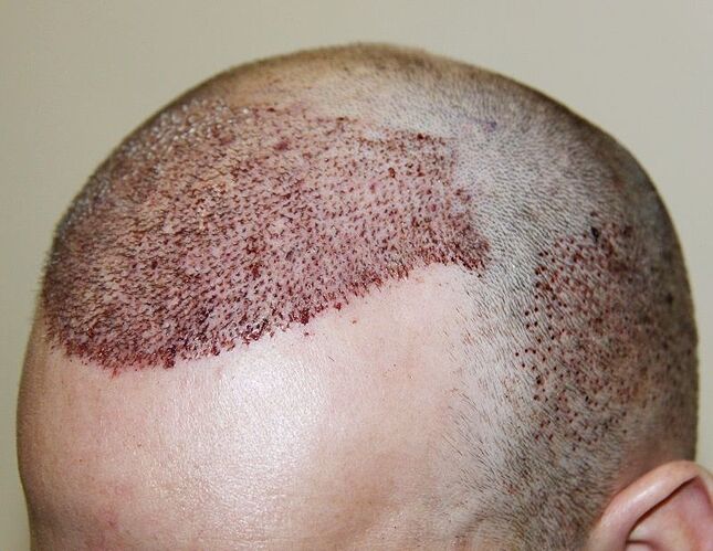 Dr. Bisanga - BHR Clinic / 2691 FUE - Frontal Repair / Manual Punch photo