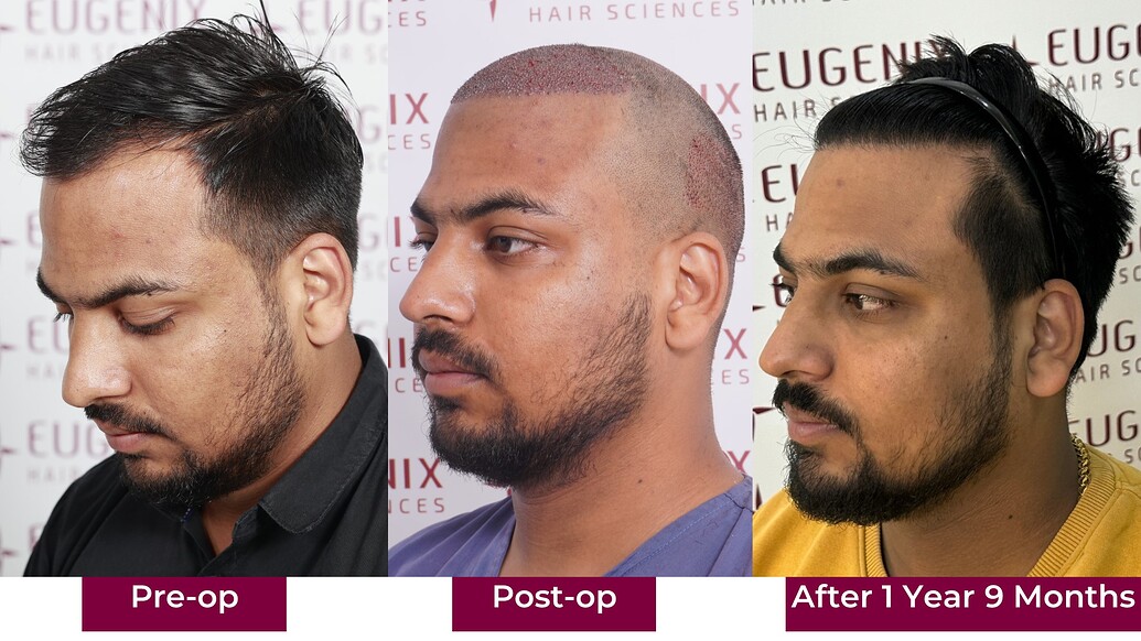 https://cdn.forumhairtransplant.com/optimized/3X/c/b/cbdb715ea44bcbc76c96f51c194871e724271534_2_1035x582.jpeg