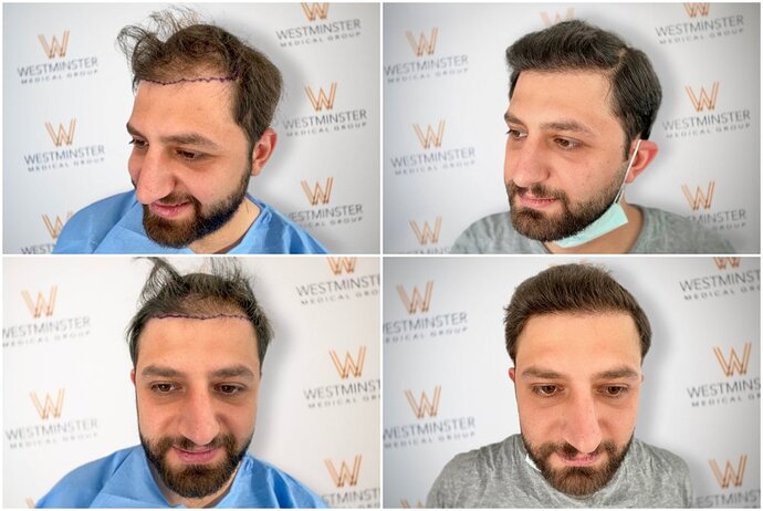 Westminster Medical Group London - 3200 Grafts - 12 Months Progress photo