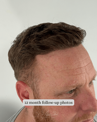 Dr Shah (London, UK) 3114 FUE grafts (0-12 months) photo