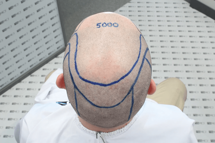 ASMED, Istanbul: 5,071 Manual FUE Grafts 0/12 Months photo