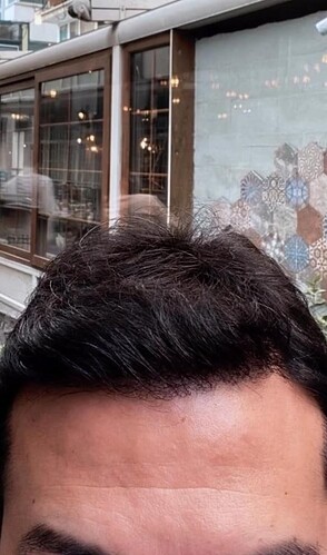 DR HAKAN DOGANAY/ 4500 GRAFTS / Implanter Pen+FUE photo