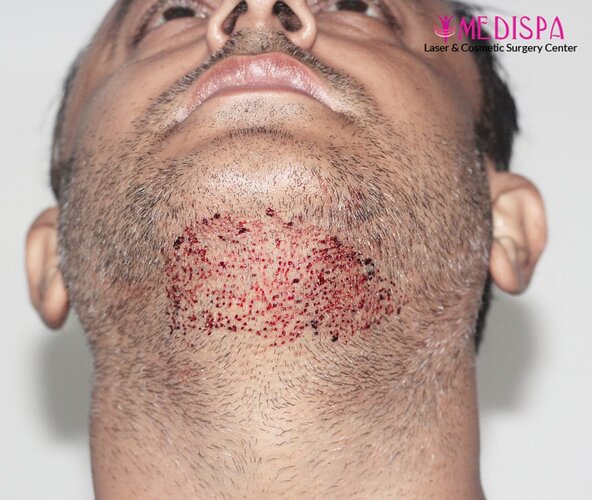 Dr. Suneet Soni - 5000 Grafts, Combine FUT + FUE + BHT (Beard) Technique, NW-V, 2.5 Year Result photo