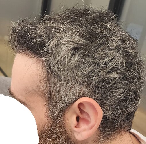 Result of Class 3V Patient – 3530 Grafts – HDC Hair clinic – Dr Maras photo