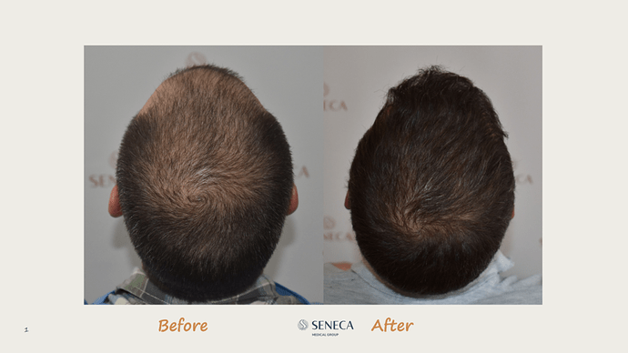 Seneca Medical Group - 2308 grafts with Direct Fue photo