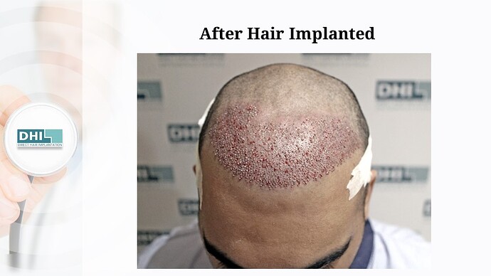 DHI India | NW 5 | 3,080 Grafts | 20-Months DHI Hair Transplant Results photo