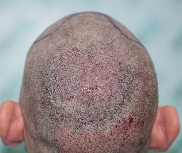Result of Class 3V Patient – 3530 Grafts – HDC Hair clinic – Dr Maras photo