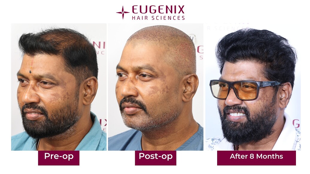 https://cdn.forumhairtransplant.com/optimized/3X/c/d/cd66cefe404d3c10041f15ec6f614d072a840500_2_1035x582.jpeg