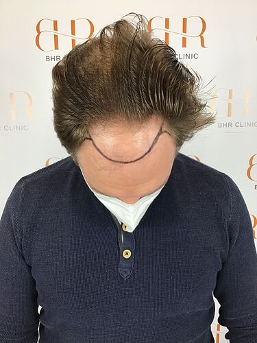 Dr.Bisanga, BHR Clinic, 2977 FUE 0 - 7 Months. photo