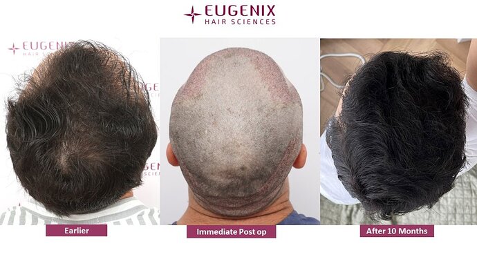 Dr. Somesh| Eugenix Hair Sciences Clinic | NW 3 | 3007 Grafts | 10 Months Post-op photo